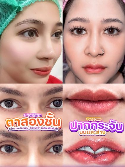 โปรศัลยกรรม ครบวงจร